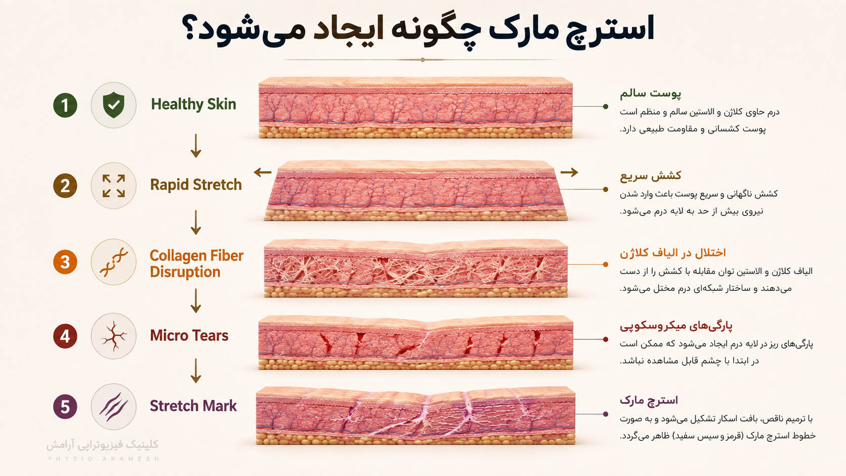 استرچ مارک چگونه ایجاد میشود